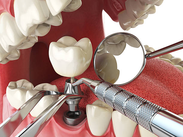 Best Emergency Root Canal Treatment in Temple Terrace, FL